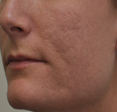 Acne Scarring
