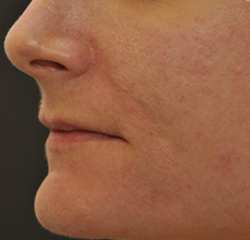 Acne Scarring