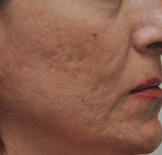 Acne Scarring