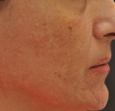 Acne Scarring