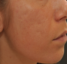 Acne Scarring