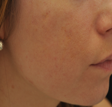 Acne Scarring