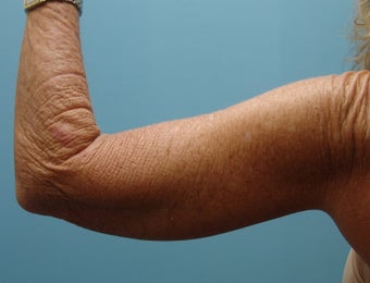 Full Extended Brachioplasty