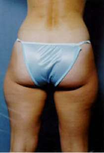 Suction Lipectormy of Inner and Outer thighs