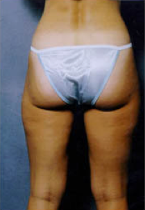 Suction Lipectormy of Inner and Outer thighs