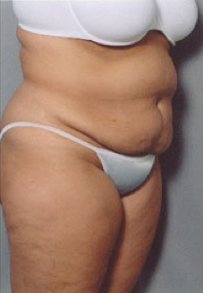Tummy Tuck