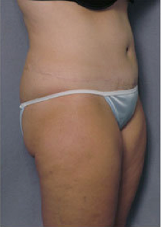 Tummy Tuck