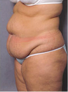Adominoplasty