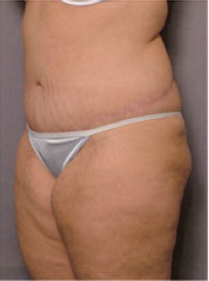 Adominoplasty
