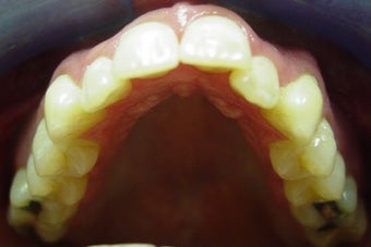 Invisalign