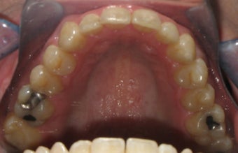 Invisalign