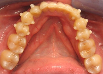 Invisalign Treatment 