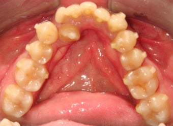 Invisalign Treatment 