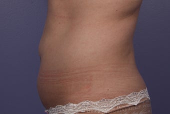 CoolSculpting to Abdomen
