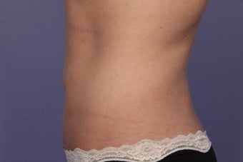 CoolSculpting to Abdomen