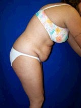 Tummy Tuck (Abdominoplasty)