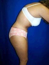 Tummy Tuck (Abdominoplasty)