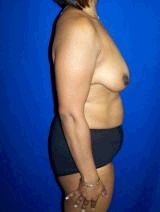 Tummy Tuck (Abdominoplasty), Breast Asymmetry, Breast Lift with Implants