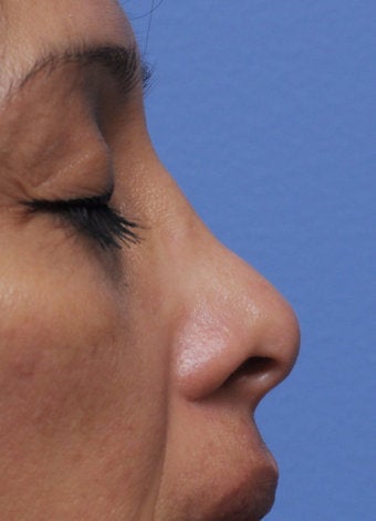 Non-Surgical Nose Job