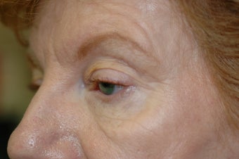 Midface Lift, upper and lower eyelid surgery