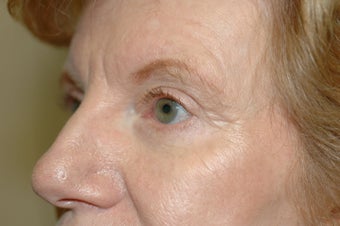 Midface Lift, upper and lower eyelid surgery