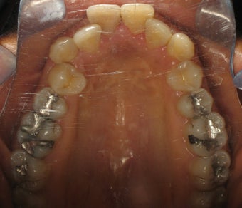 Invisalign performed 