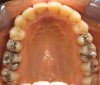 Invisalign performed 