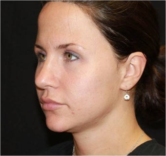 Ultherapy