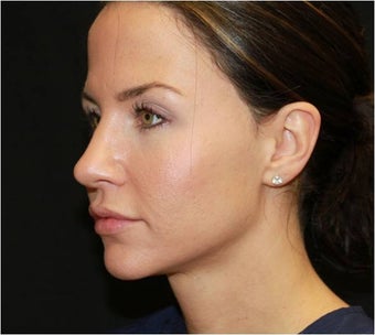Ultherapy