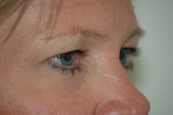 Forehead Lift
