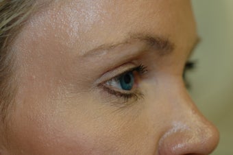 Forehead Lift