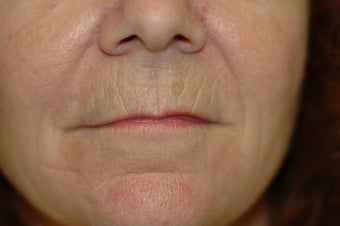 Laser skin resurfacing, eyelid surgery, lip augmentation