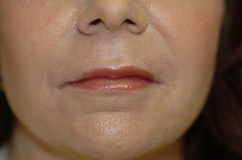 Laser skin resurfacing, eyelid surgery, lip augmentation