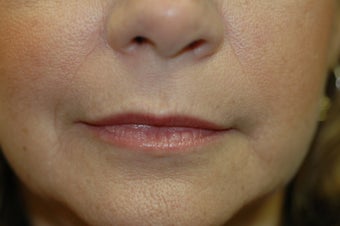 Hetter facial resurfacing