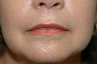 Hetter facial resurfacing