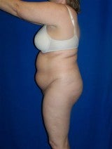 Tummy Tuck (Abdominoplasty)