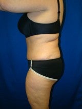 Tummy Tuck (Abdominoplasty)