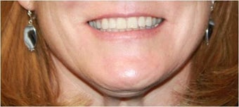 Lip augmentation - juvederm