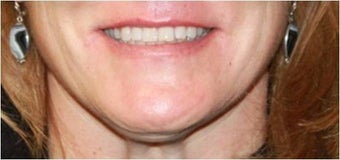 Lip augmentation - juvederm