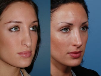 Revision rhinoplasty