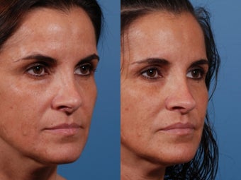 Revision rhinoplasty