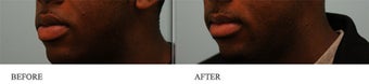 Upper and Lower Lip Reduction