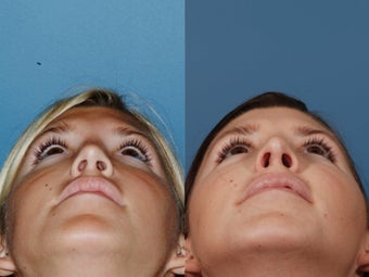 Revision rhinoplasty