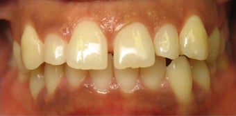 Invisalign 