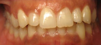 Invisalign 