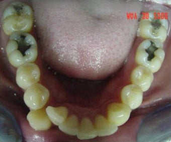 Invisalign 