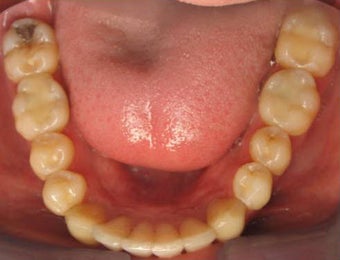 Invisalign 