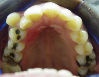 Invisalign