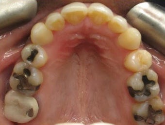 Invisalign