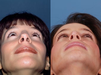 Revision rhinoplasty